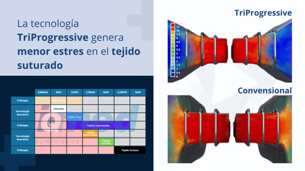 Tecnología TriProgressive Versus tecnología Convensional